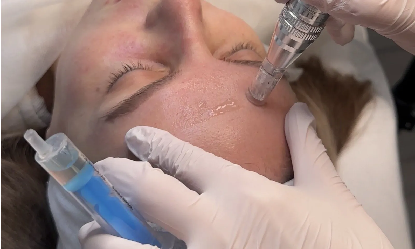 Що таке мікронідлінг і кому він підходить?