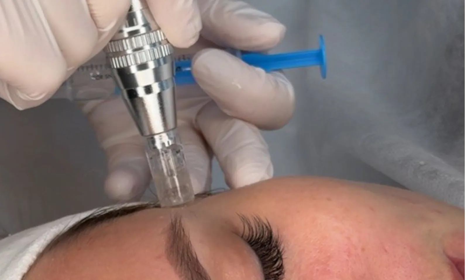 МЕЗОПІЛ: Сила комбінації пілінгу та мікронідлінгу