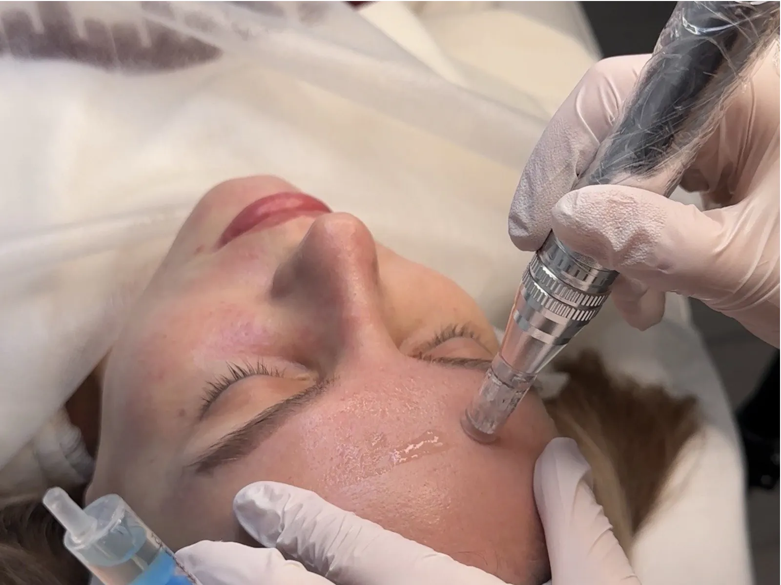 Microneedling — Sebum Balance