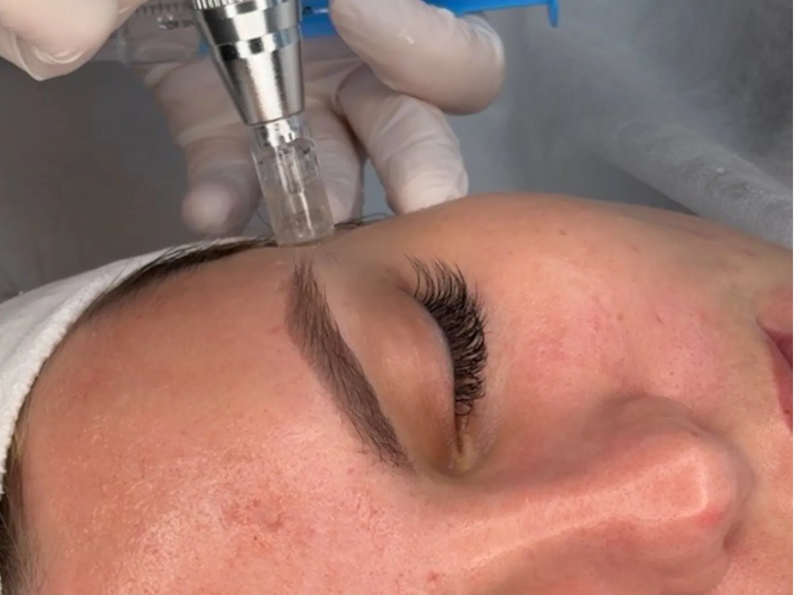 Microneedling — Skin Reglow