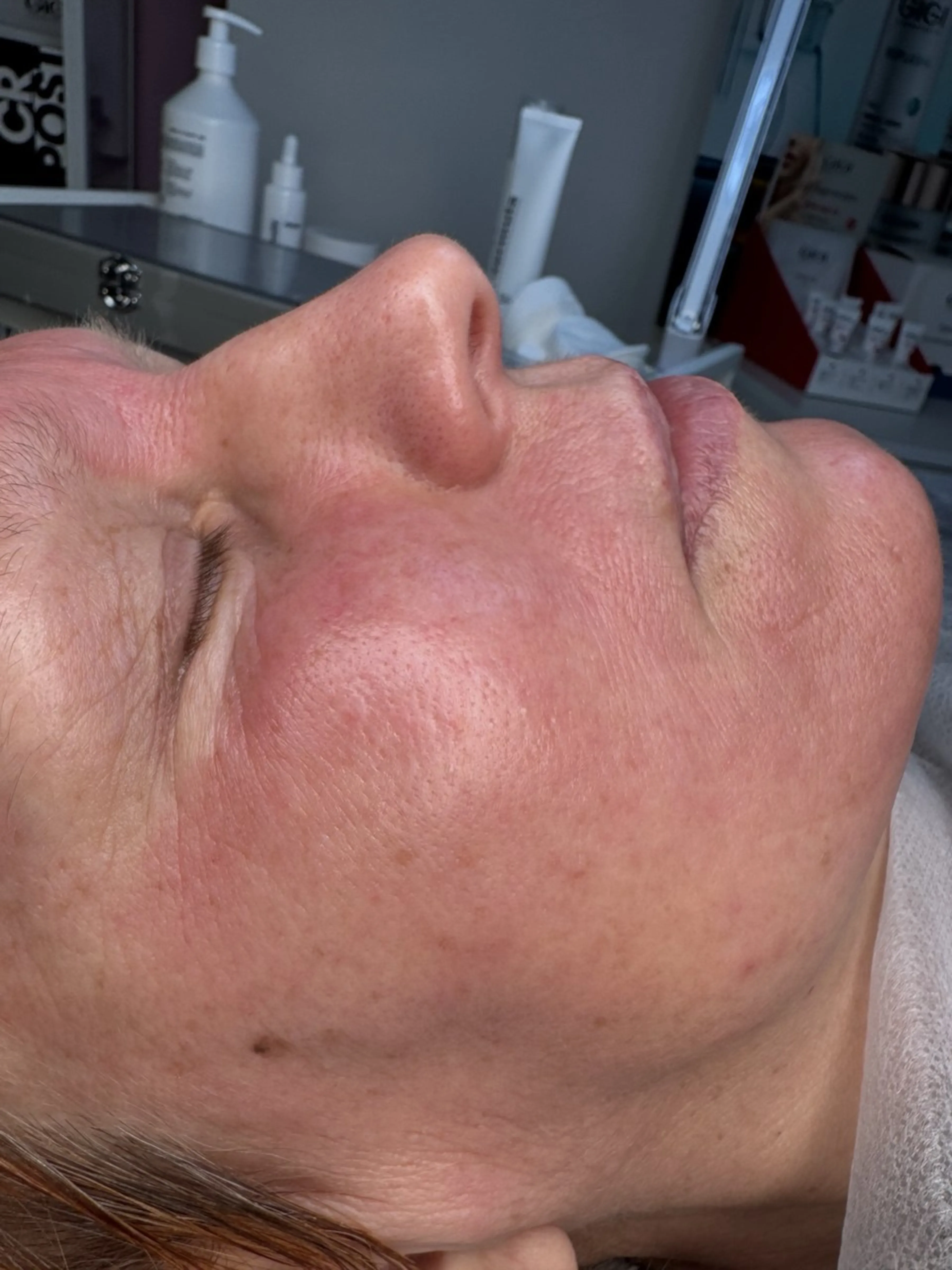 MEZOPEEL peeling — výsledek po jednom ošetření — Po