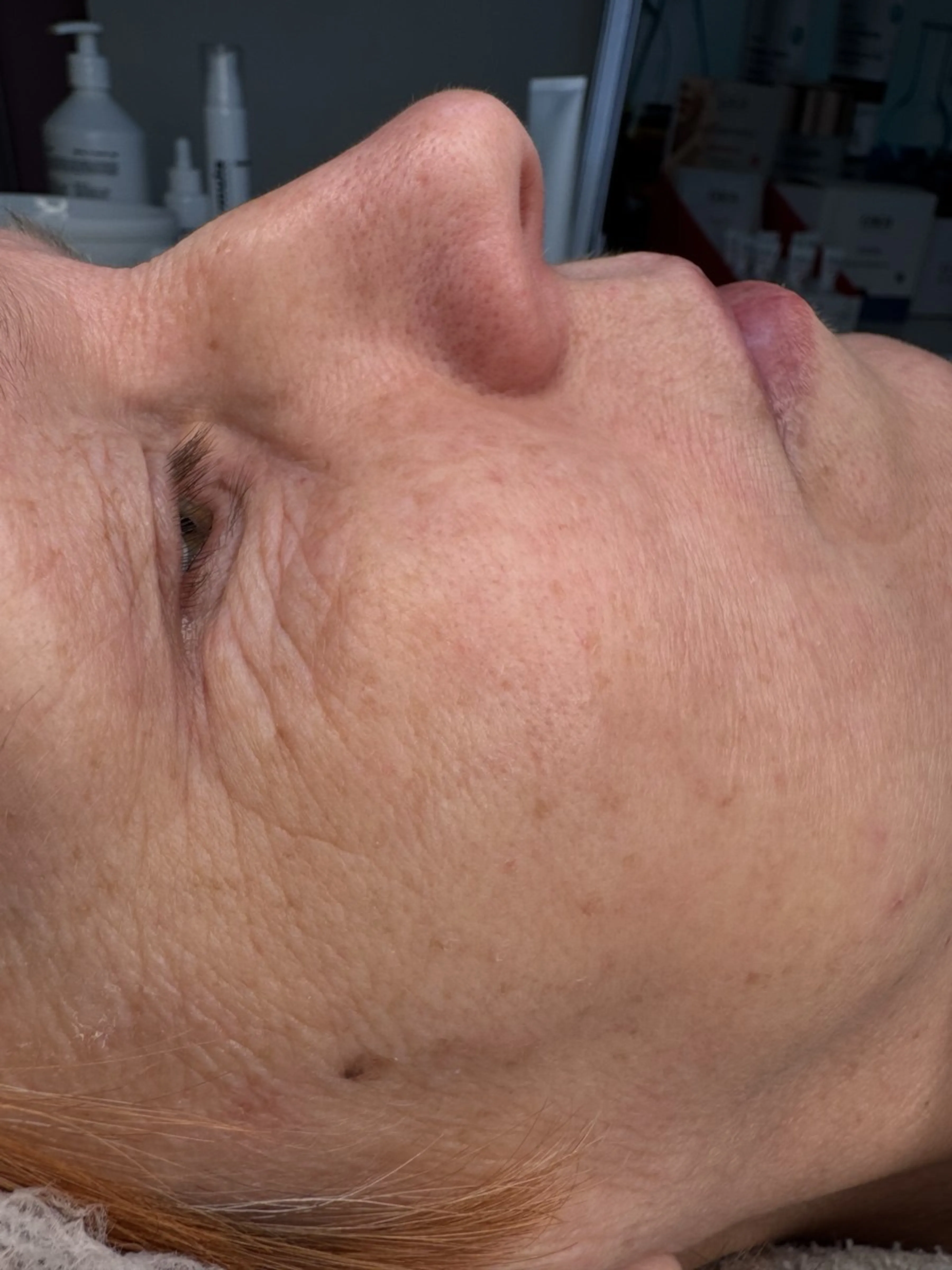 MEZOPEEL peeling — výsledek po jednom ošetření — Před